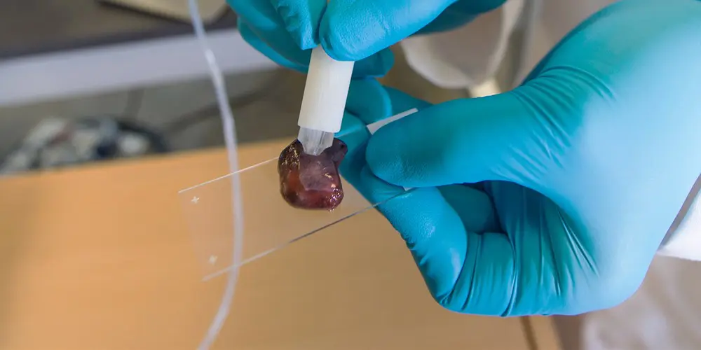 The MasSpec pen can detect cancerous tissue in an instant (photo fromVivian Abagiu / Univ. of Texas at Austin