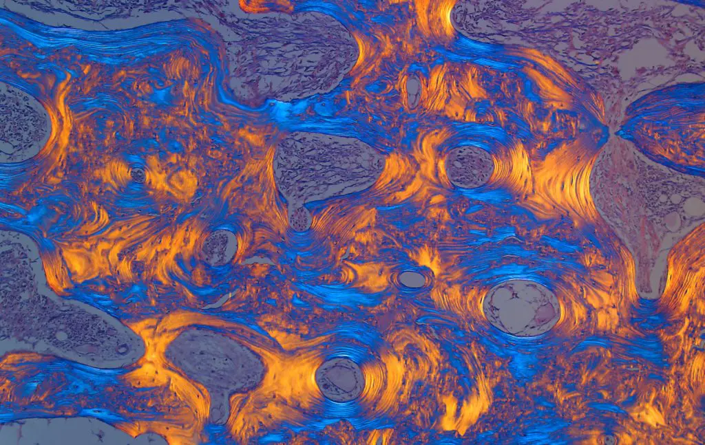  microscopic look at Pagets disease from The Health Museum's "Body as a Work of Art: More Than Skin Deep" exhibit.