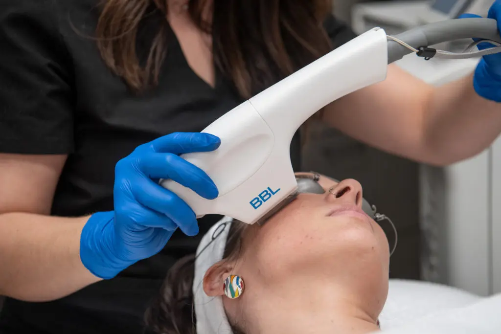 BBL treats age spots, sun damage, redness, broken facial vessels, wrinkles and dull skin.