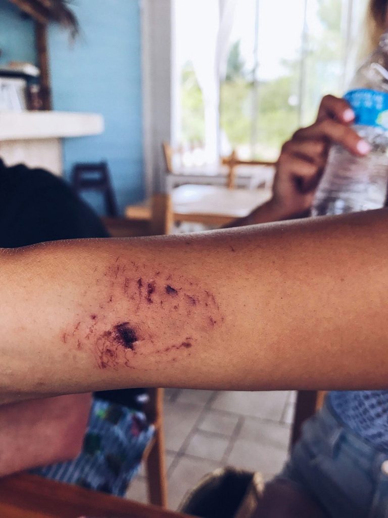 Doctors say the bite will leave a scar. 