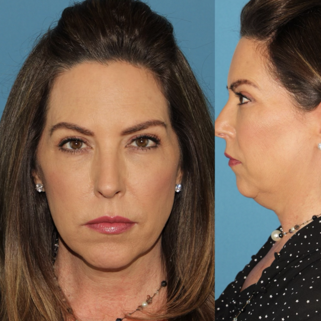 Before surgery with Dr. Sanaz. 